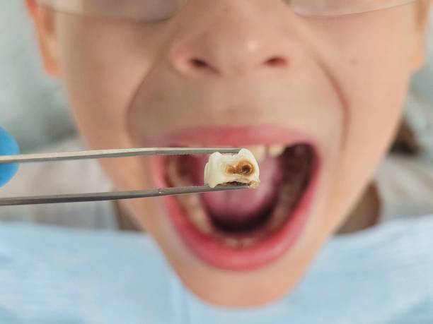 Best Emergency Dental Care for Broken or Chipped Teeth in Perry Hall, MD